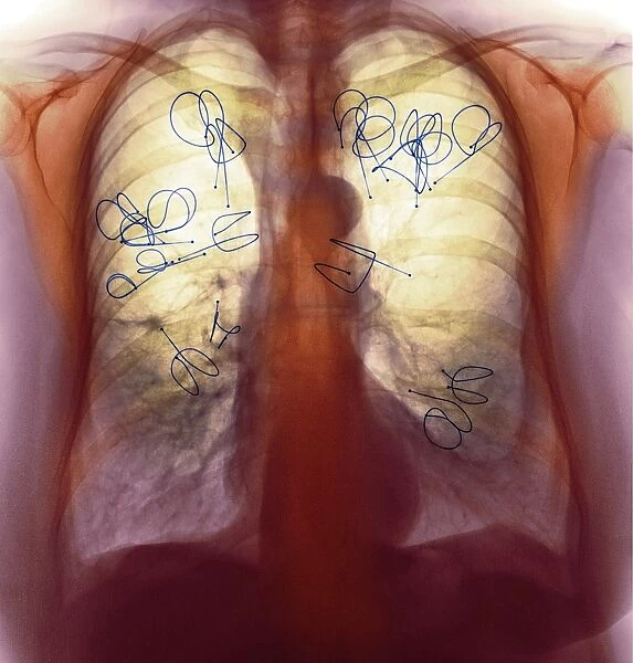 Endobronchial valves, X-ray F008  /  3469