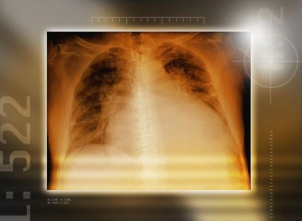 Heart failure, chest X-ray