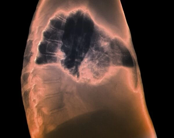 Hydropneumothorax, X-ray C018  /  0586