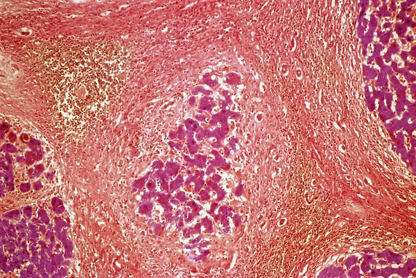Liver tissue cirrhosis, light micrograph