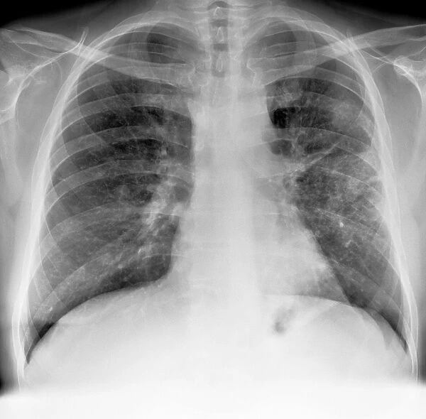 Lung cancer, X-ray C017  /  7964