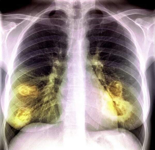 Lung lesions, X-ray