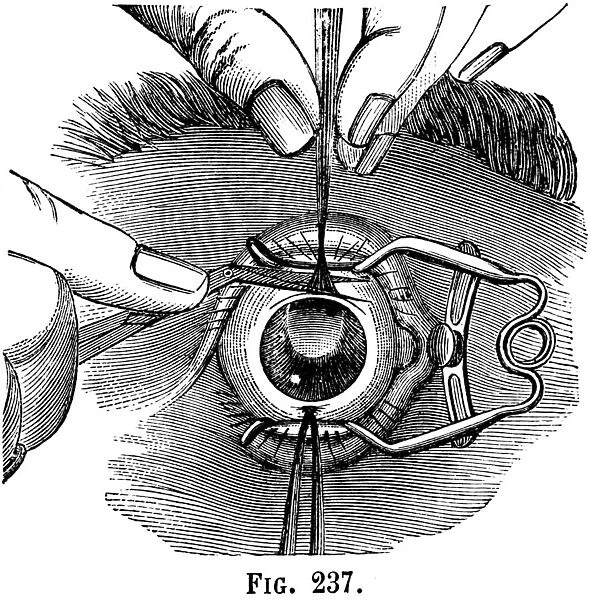Eye surgery, illustration from Dictionnaire de Medecine d Emile Littre, 1884 (litho)