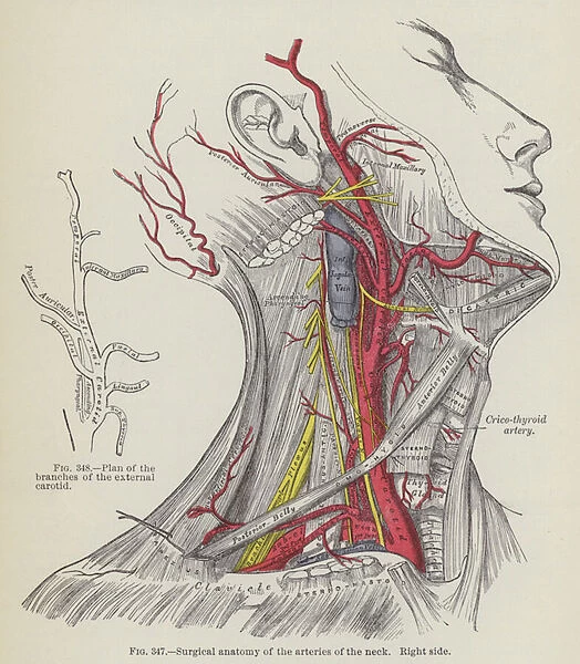 Surgical anatomy of the arteries of the neck, right side (engraving)