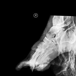 Crushed right foot, X-ray C017 / 8012
