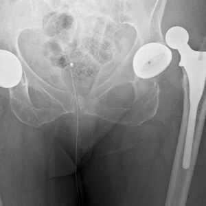 Dislocated hip replacement, X-ray