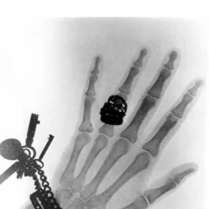 Early X-ray photograph of a hand taken in 1896