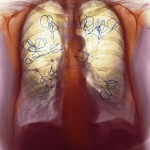 Endobronchial valves, X-ray F008 / 3469