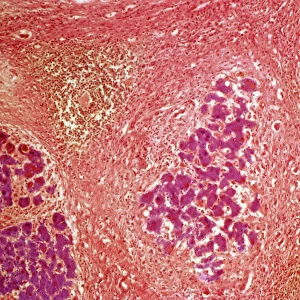Liver tissue cirrhosis, light micrograph