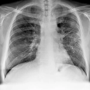 Lung cancer, X-ray C017 / 7964