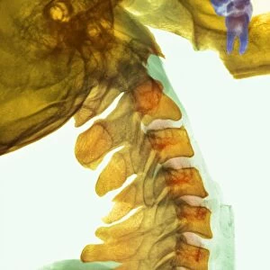 Neck vertebrae flexed, X-ray