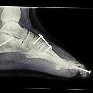 Pinned foot bones after surgery, X-ray