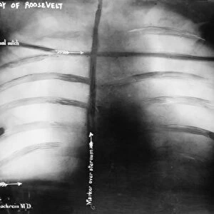 Roosevelt bullet, 1912 chest X-ray C016 / 2549