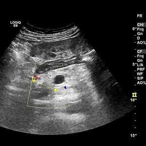 Secondary pancreatic cancer, ultrasound C017 / 7765