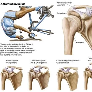 Anatomy of acromioclavicular joint rupture and displacement