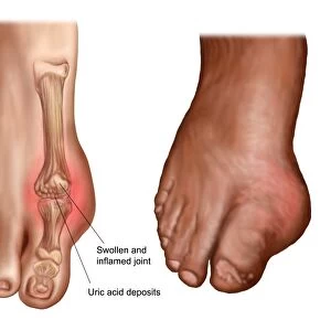 Anatomy of a swollen foot